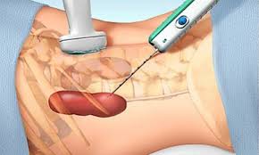 Kidney Biopsy for Children and Adults