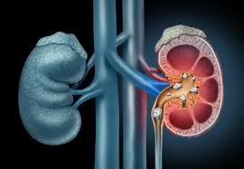 Recurrent Kidney Stone Formation