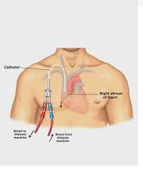 Vascular Access